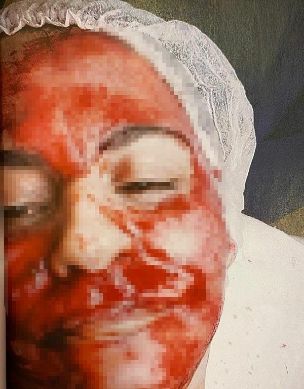 Şişli'de cilt bakımı sonrası yüzü kanlar içinde kalan B.Y.