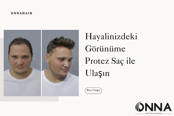 Hayalinizdeki Görünüme Protez Saç ile Ulaşın