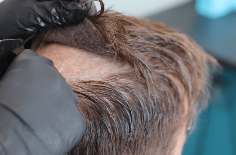 Protez Saç ile Hayata Yeniden Gülümseyin